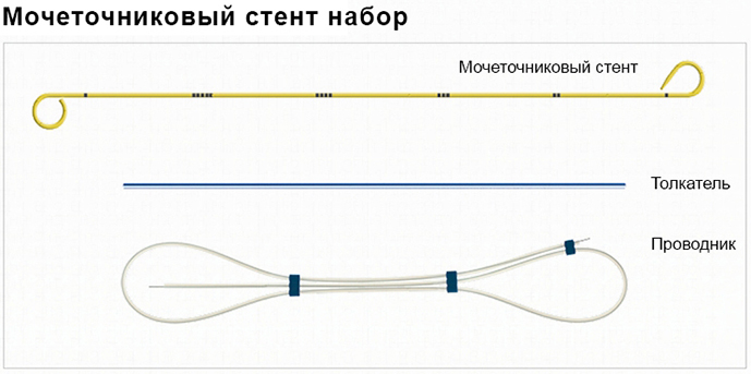 мочеточниковый стент